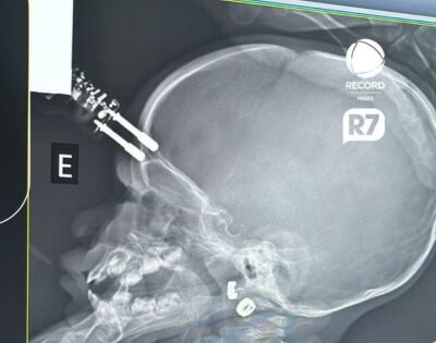 Imagem da notícia Bebê cai da cama e fica com pino de carregador cravado na testa em Minas Gerais